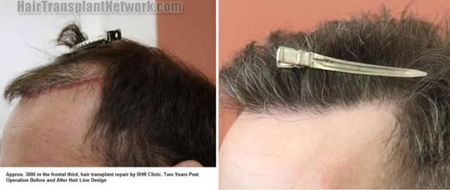 Hair transplantation surgery before and after pictures