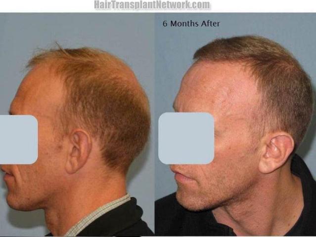 Hair transplantation surgery before and after pictures