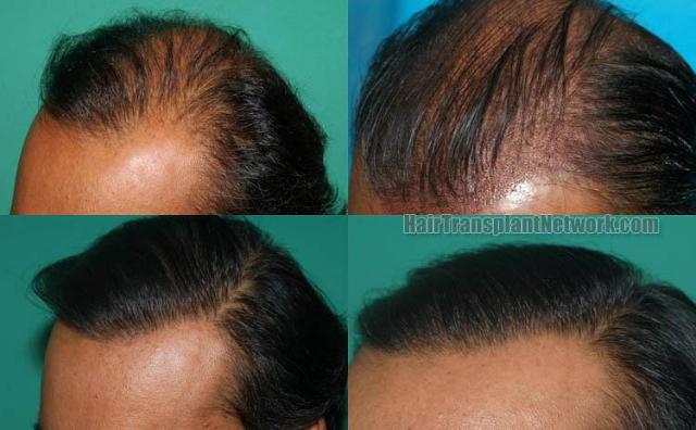 Hair transplantation surgery before and after photos