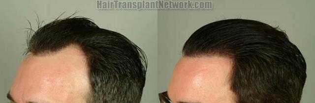 Hair restoration procedure before and after pictures