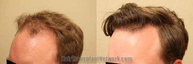 Hair restoration surgical procedure before and after pictures