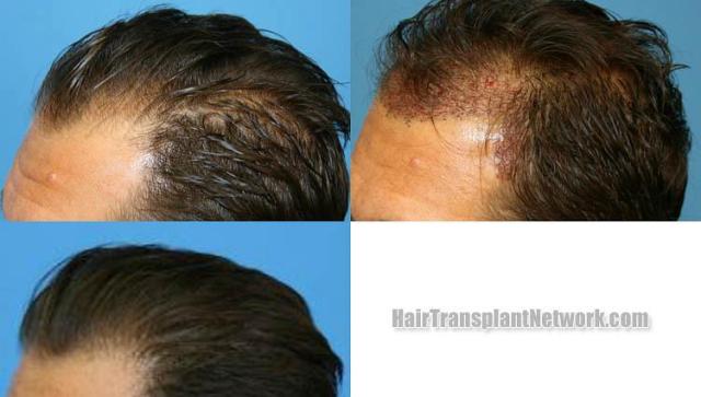 Hair transplantation surgery before and after photos