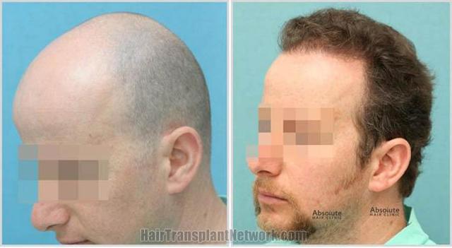 Hair restoration procedure before and after pictures