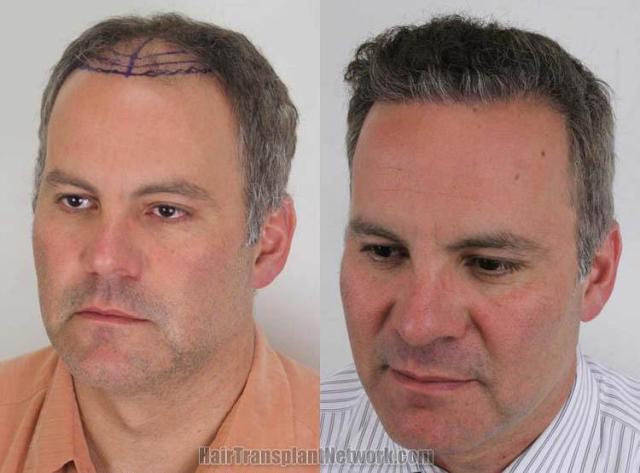 Hair transplantation surgery before and after pictures