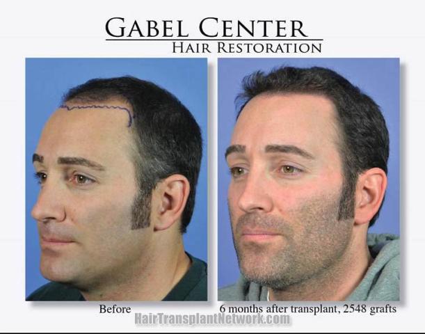 Hair transplantation surgery before and after pictures