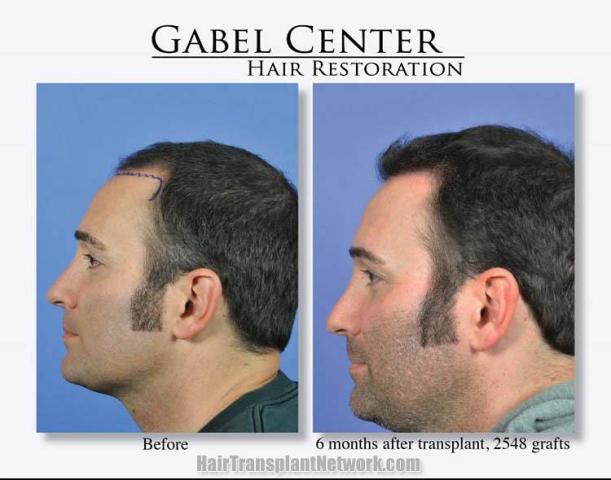 Surgical hair transplantation result photographs