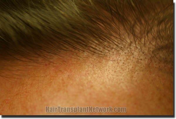 Hair restoration procedure results