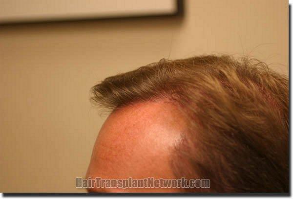 Hair restoration procedure results