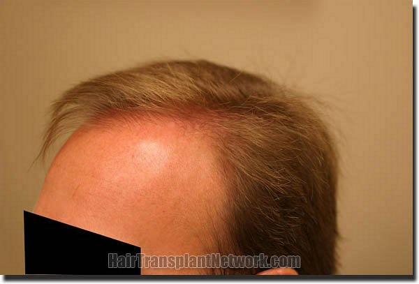 Hair restoration procedure results