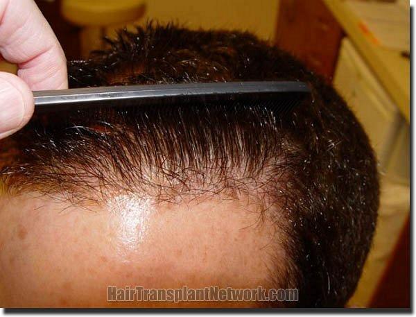 Hair restoration procedure results