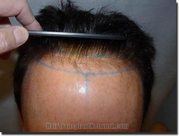 Hair restoration procedure results