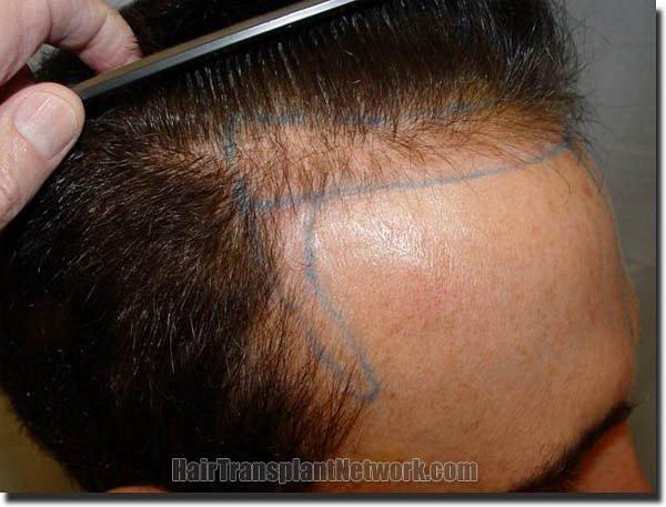 Hair restoration procedure results