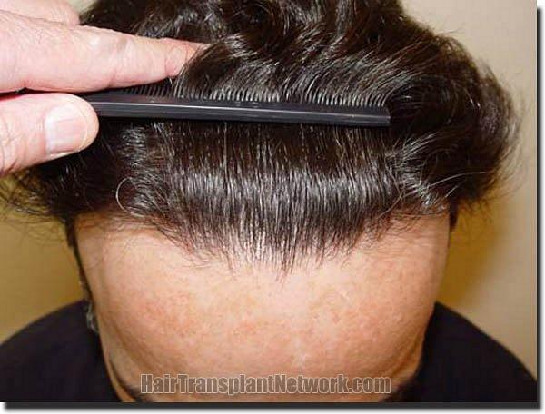 Hair restoration procedure results