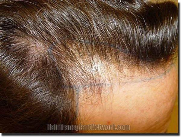 Hair restoration procedure results