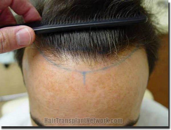 Hair restoration procedure results