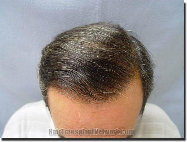 Hair restoration procedure results