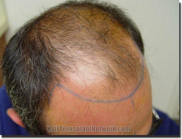 Hair restoration procedure results