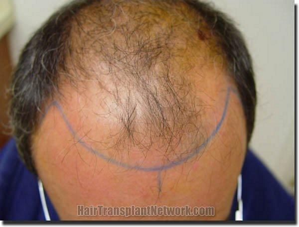 Hair restoration procedure results