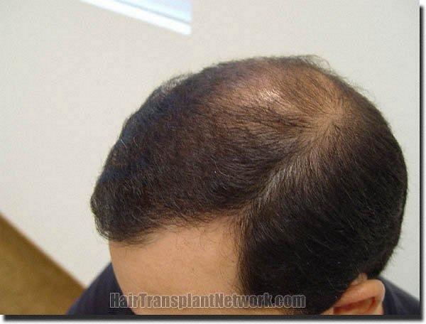 Hair restoration procedure results