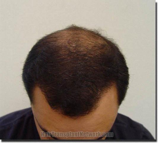 Hair restoration procedure results