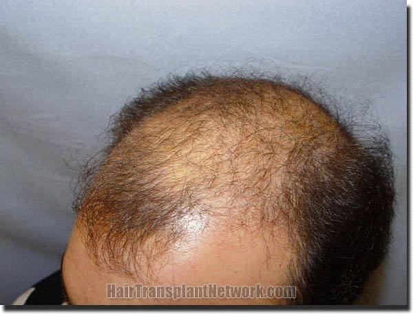 Hair restoration procedure results