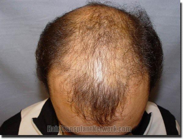 Hair restoration procedure results