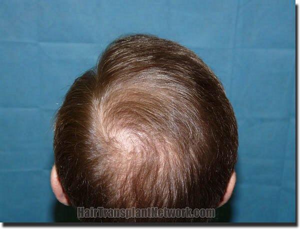 Hair restoration procedure results