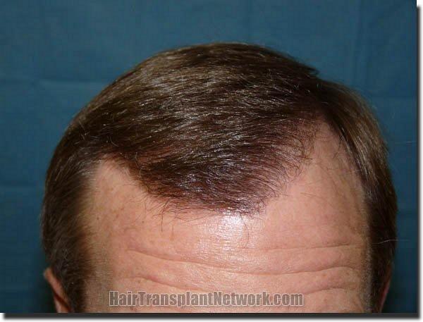 Hair restoration procedure results