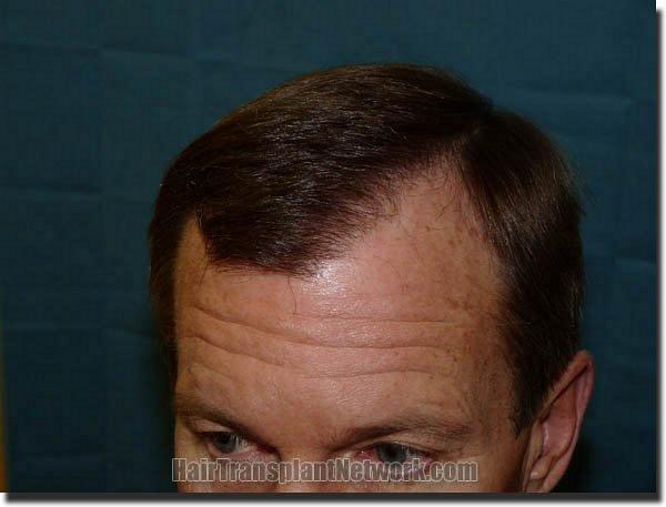 Hair restoration procedure results