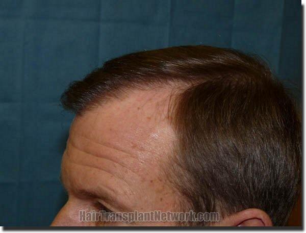 Hair restoration procedure results