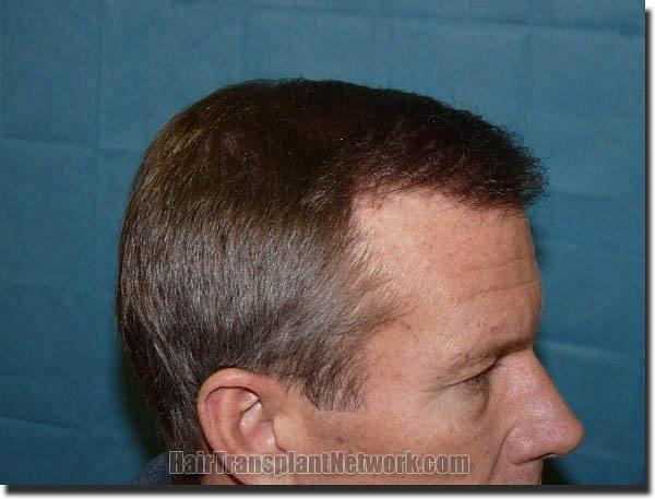 Hair restoration procedure results