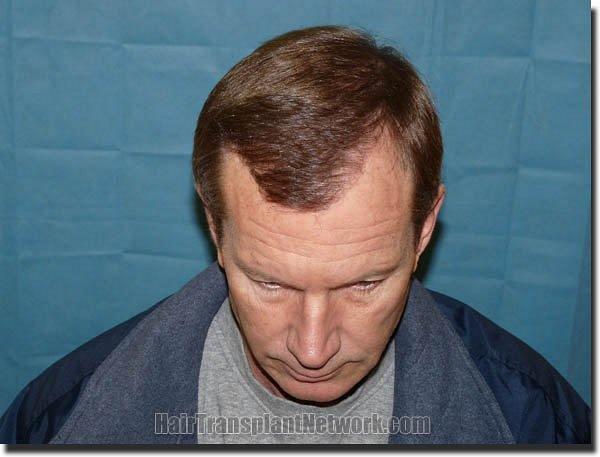 Hair restoration procedure results