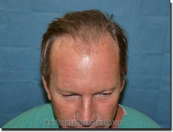 Hair restoration procedure results