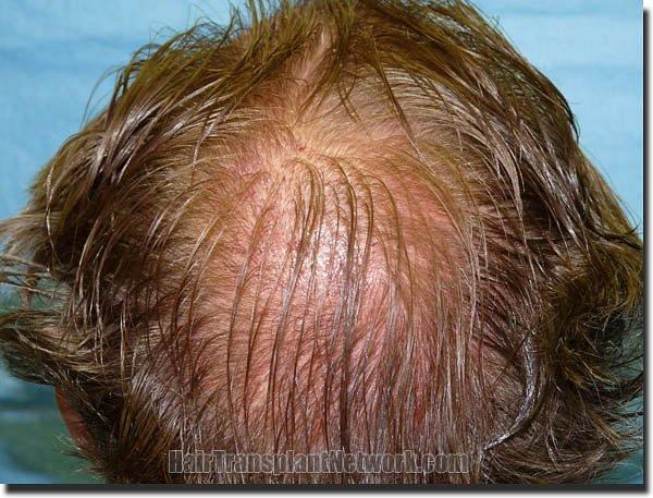 Hair restoration procedure results