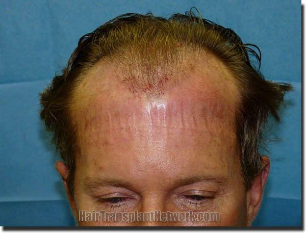 Hair restoration procedure results