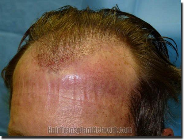 Hair restoration procedure results