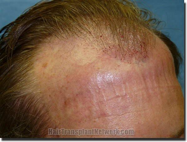 Hair restoration procedure results