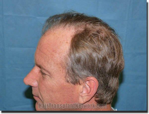 Hair restoration procedure results