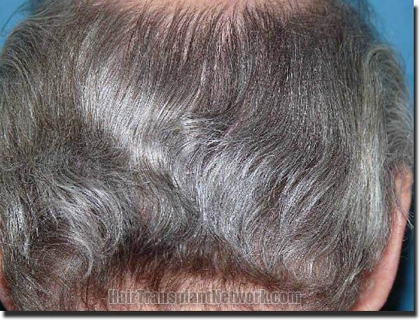 Hair restoration procedure results