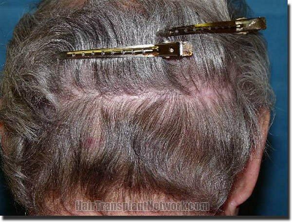 Hair restoration procedure results