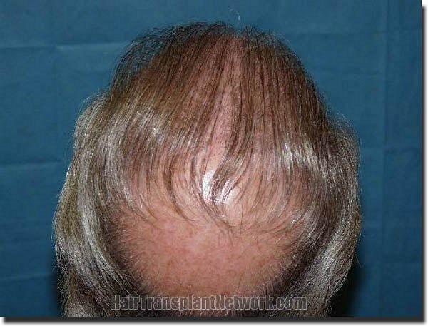 Hair restoration procedure results