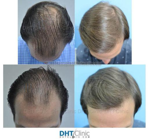 Hair transplantation surgery before and after images