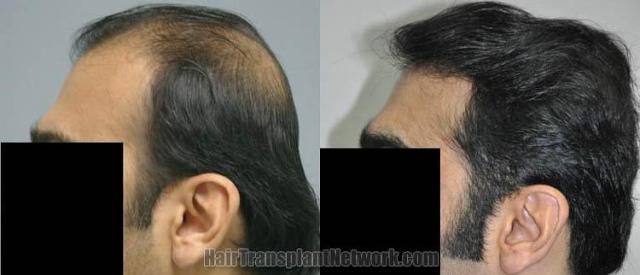 Hair restoration procedure before and after pictures