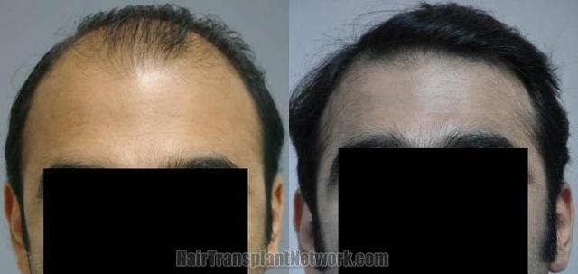 Hair restoration procedure results