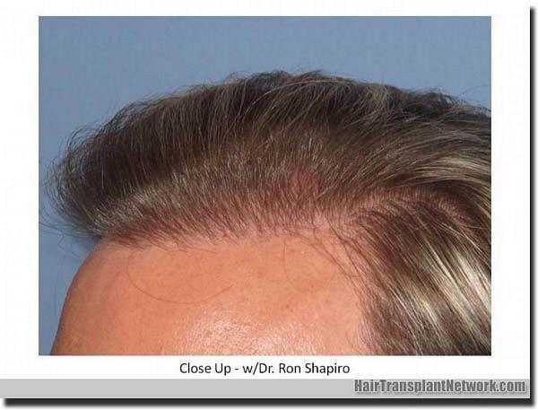 Hair restoration procedure results