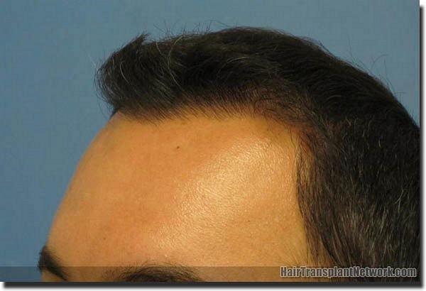 Hair restoration procedure results