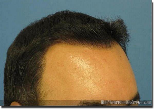 Hair restoration procedure results