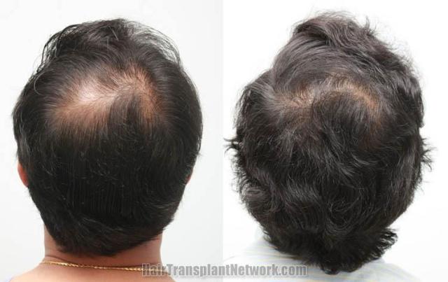 Hair restoration procedure before and after pictures