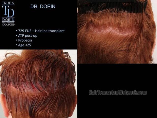 Hair transplantation surgery before and after pictures