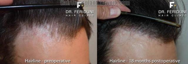 Hair transplantation surgery before and after photos